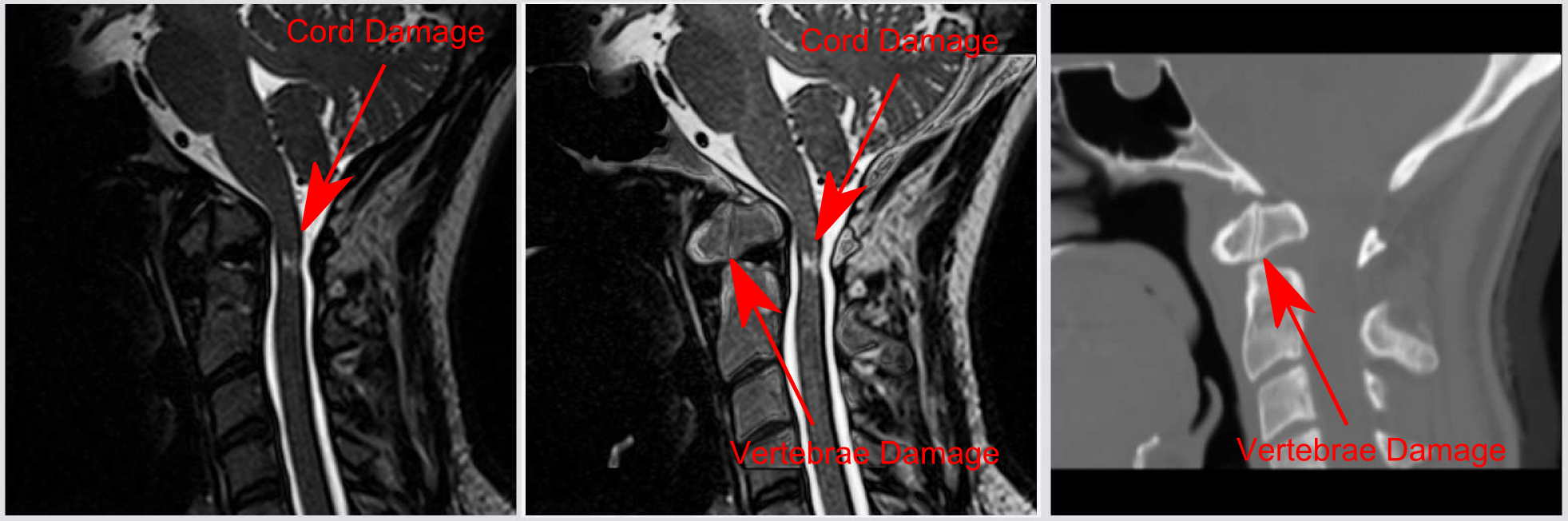 Spine Image Fusion: Spine CT and MRI