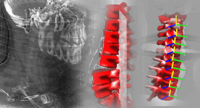 spine recognition modelling 2d and 3d
